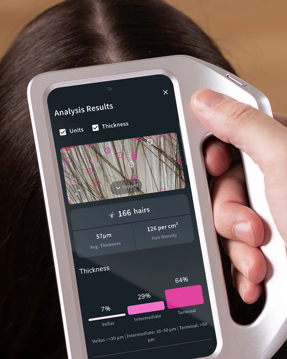 Digital trichoscopy — the device measures hair density and thickness at the parting